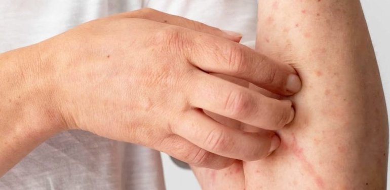 Bu Belirti Varsa Dikkat! Covid-19 Olmuş Olabilirsiniz… Her 5 Kişiden 1’inde Görülüyor