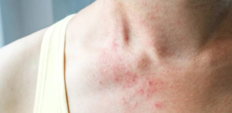 Dikkat: Covid- 19 vakalarında ‘deride döküntü’ tehlikesi