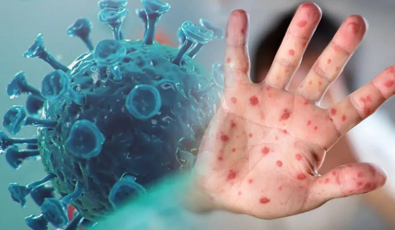 Sağlık Bakanlığı, ‘maymun çiçeği virüsü’ hakkındaki merak edilen soruları yanıtladı