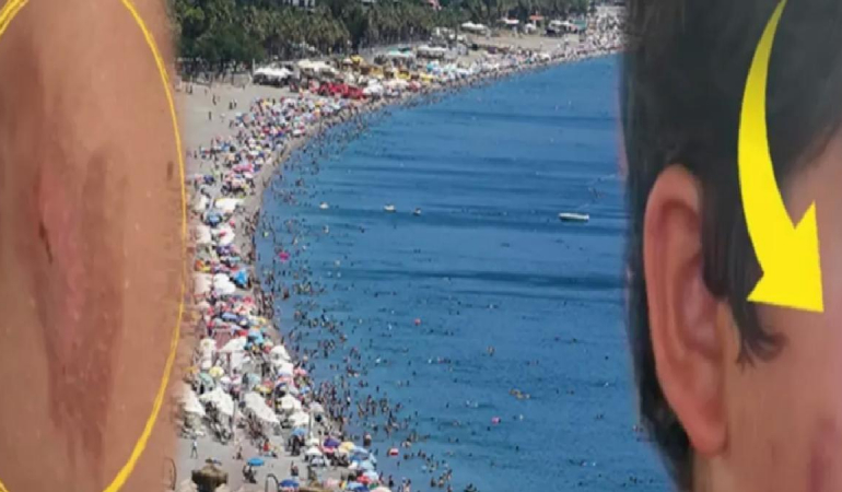 Vatandaşlar tedirgin! Denize giren yanıklarla çıkıyor